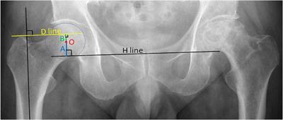 The effectiveness and influencing factors of the “Y” line technique in reducing the leg length discrepancy after total hip arthroplasty